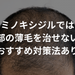 ミノキシジルでは前頭部の薄毛を治せない？！【おすすめ対策法あり】