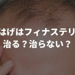 M字はげはフィナステリドで治る？治らない？【疑問を徹底解説！！】