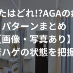 あなたはどれ!?AGAの症状パターンまとめ【画像・写真あり】〜若ハゲの状態を把握〜