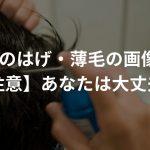 後頭部のはげ・薄毛の画像8選！【注意】あなたは大丈夫!?