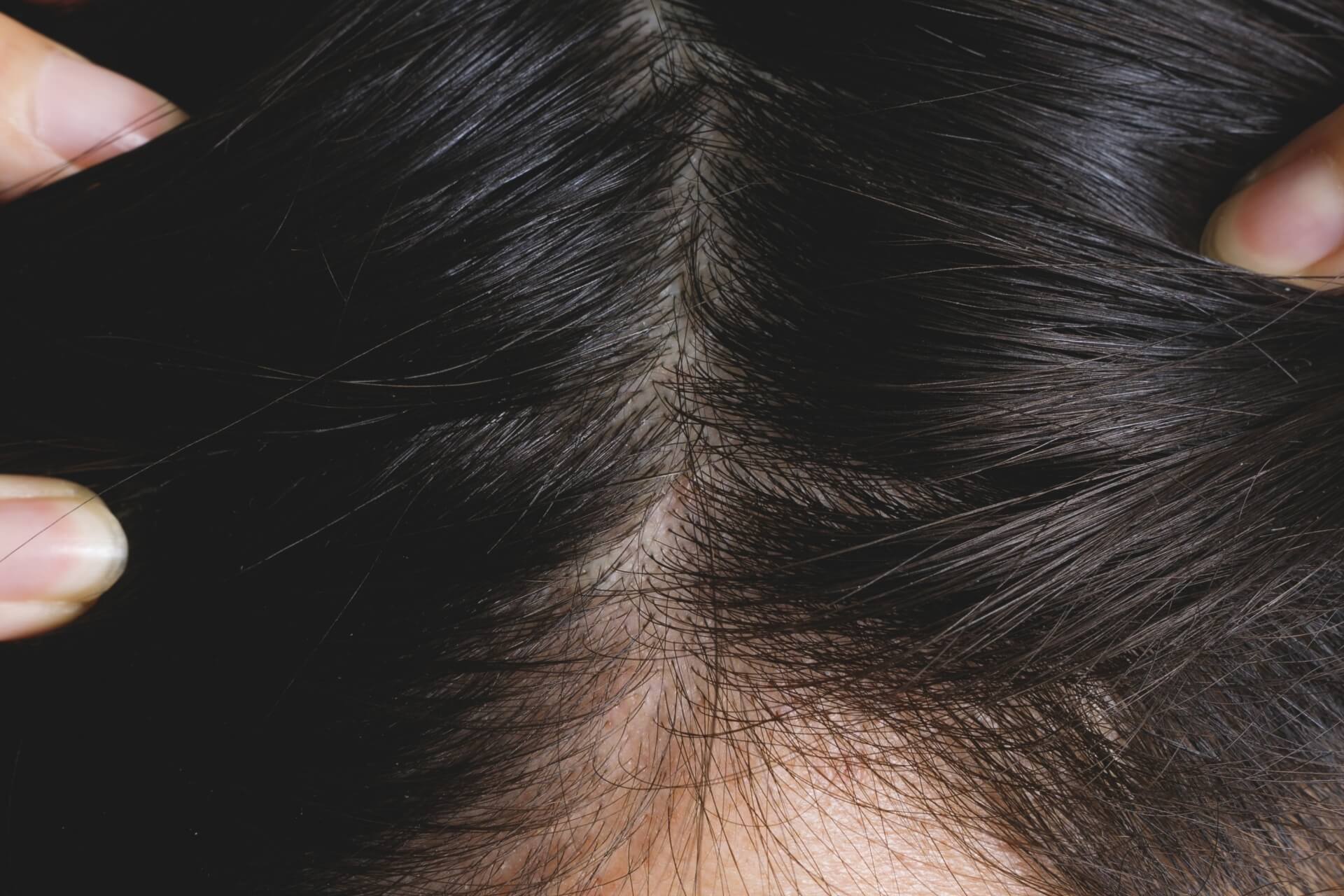 女性の薄毛 脱毛症の種類