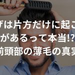 M字はげは片方だけに起こることがあるって本当!?〜前頭部の薄毛の真実〜