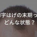 M字はげの末期ってどんな状態？