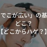 「おでこが広い」の基準はどこ？【どこからハゲ？】