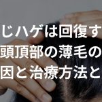 つむじ/頭頂部ハゲは回復する？頭頂部の薄毛の原因や治療方法について解説