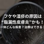 そのフケや湿疹の原因は“脂漏性皮膚炎”かも！一体どんな疾患？治療はできる？