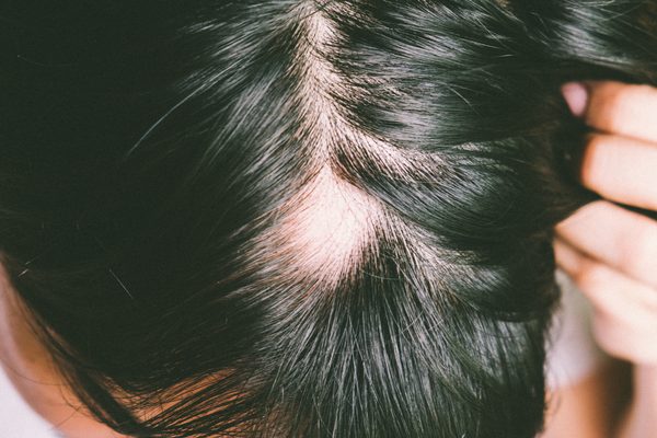 円形脱毛症の症状