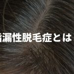 脂漏性脱毛症とは？症状や原因、治療方法などについて徹底解説