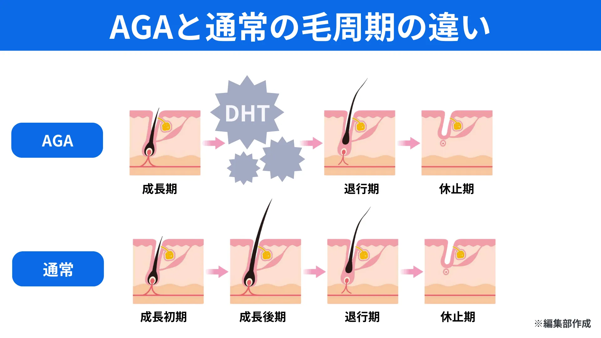 AGAと通常の毛周期の違い