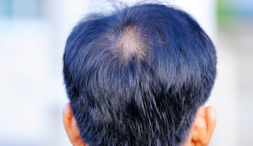 これって初期脱毛？AGA治療で抜け毛がひどくなりやすい人の特徴や対処法について