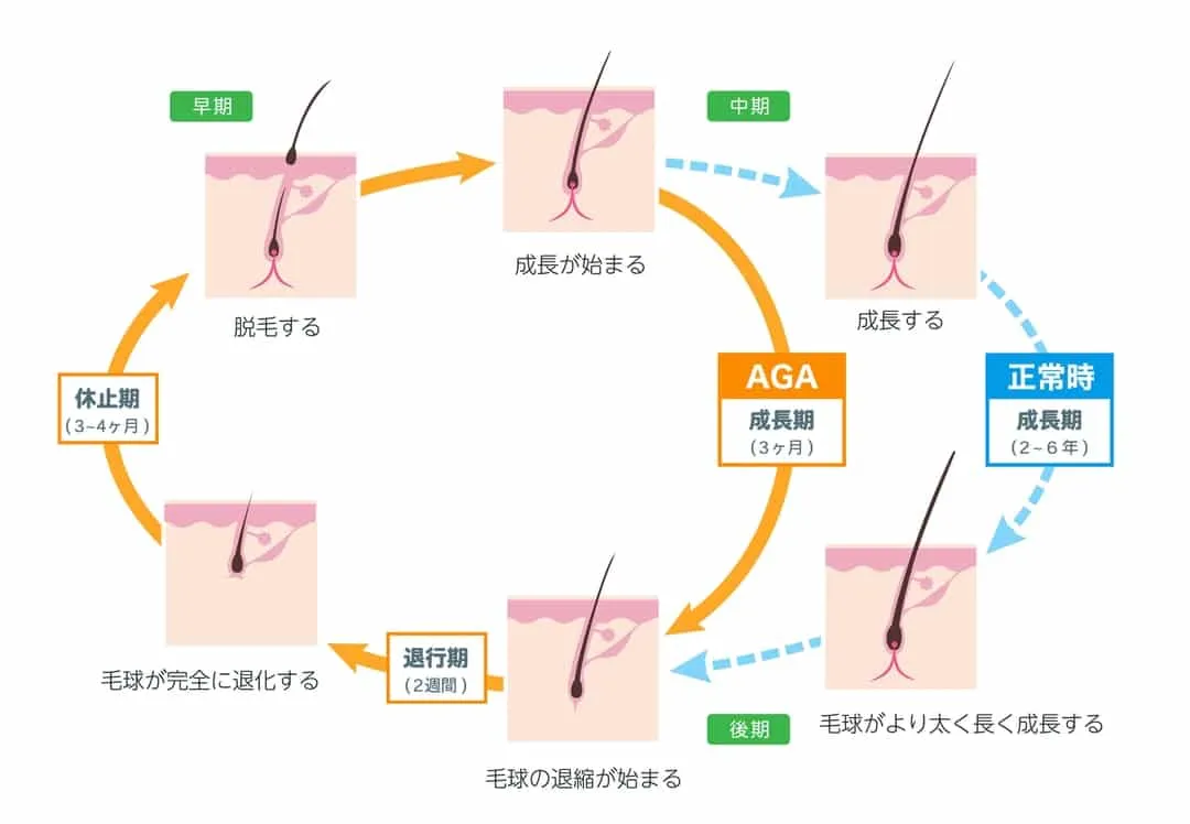 つむじはげが発生するメカニズム