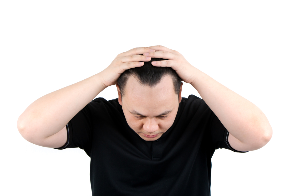 M字ハゲの見分け方や原因、治療方法について詳しく解説 | AGAスマクリ